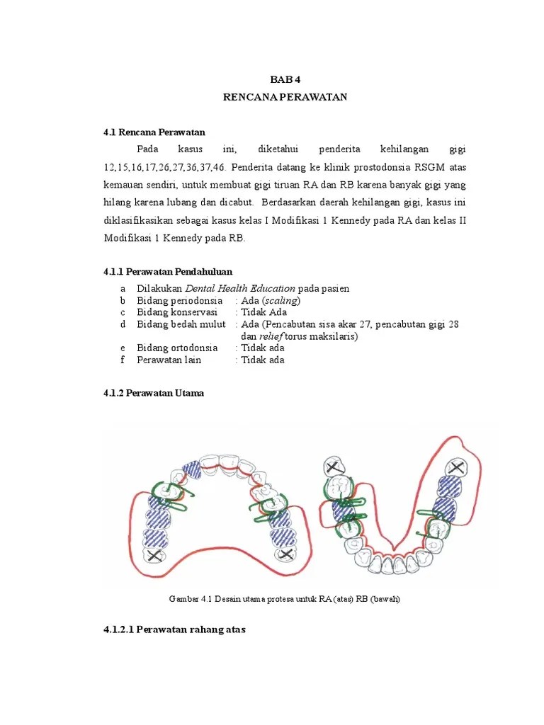 desain Gigi tiruan sebagian lepasan.