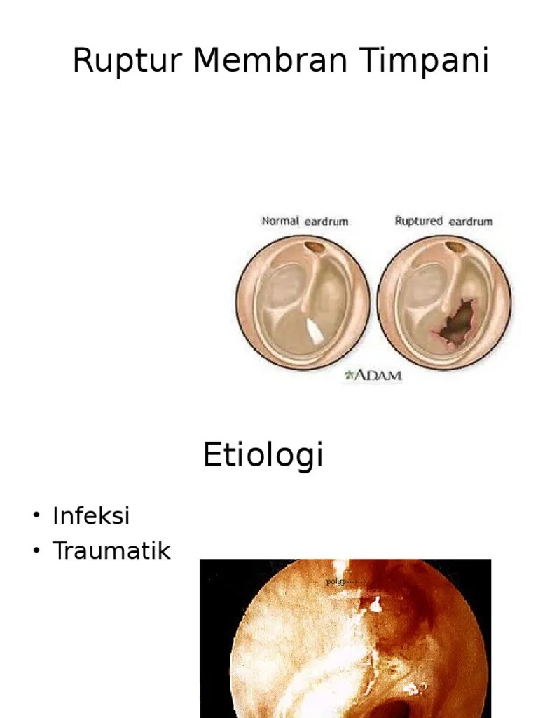 Ruptur Membran Timpani | PDF