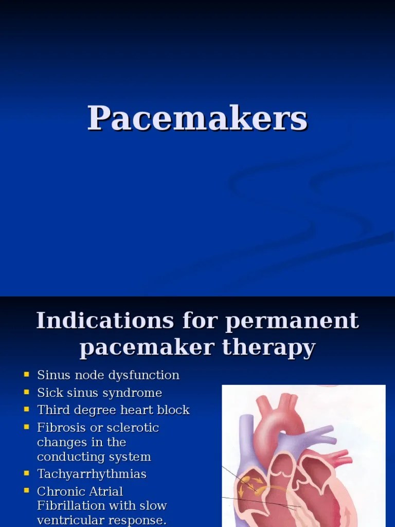 Pacemakers, Heart Blocks PDF Artificial Cardiac Pacemaker Atrium (Heart)