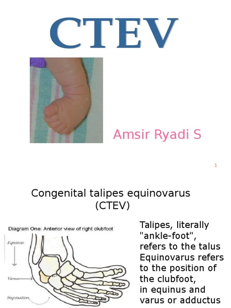 CTEV ams.ppt Foot Musculoskeletal System
