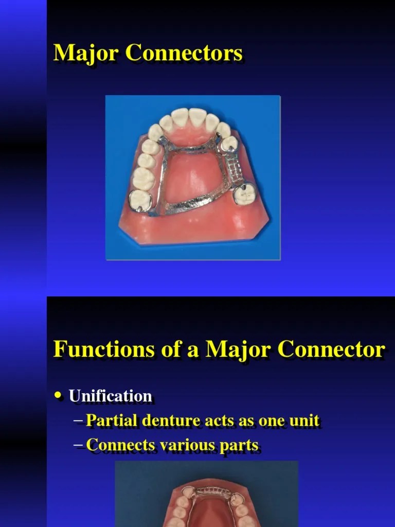Major Connectors IN RPD Anatomical Terms Of Location Dentures