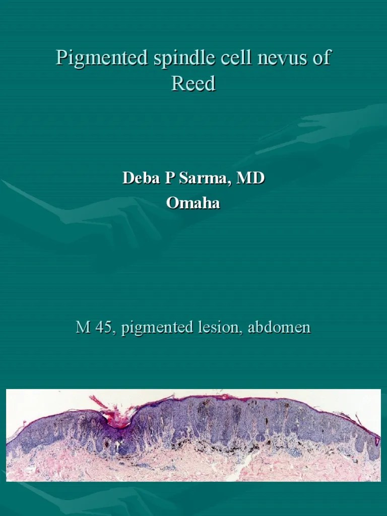 Pigmented Spindle Cell Nevus of Reed (Pigmented Epitheliod Compond