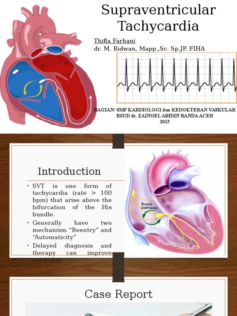 Supraventricular Tachycardia Cardiac Arrhythmia Cardiac