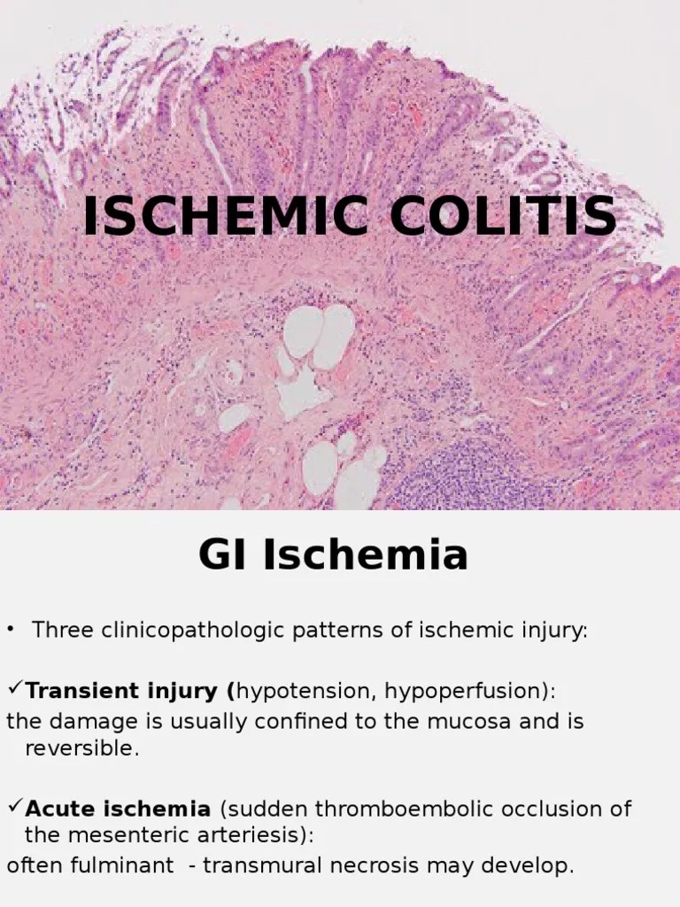 Ischemic Colitis Ischemia Anatomy