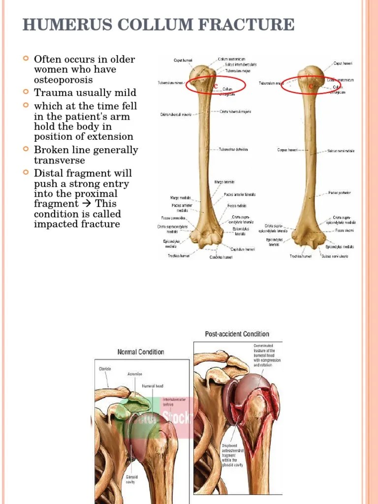fraktur humerus English Shoulder Arm