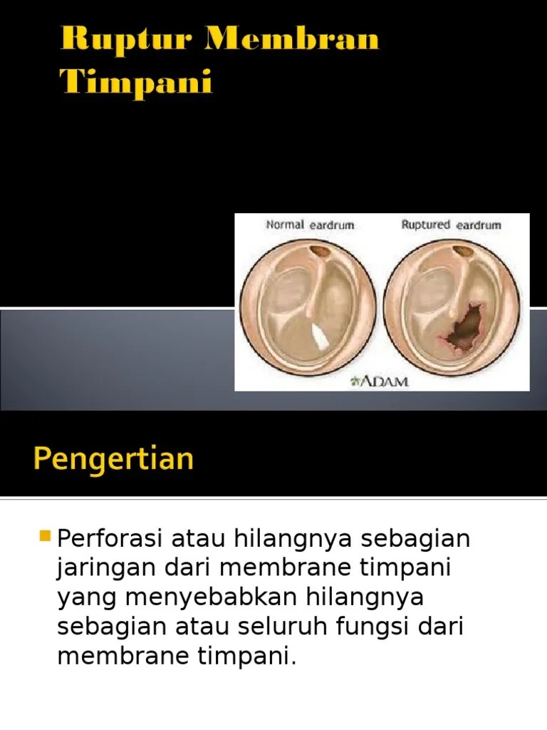 Ruptur Membran Timpani | PDF