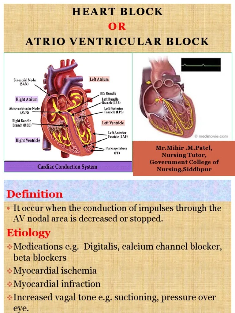 Heart Block ppt Cardiac Arrhythmia Heart
