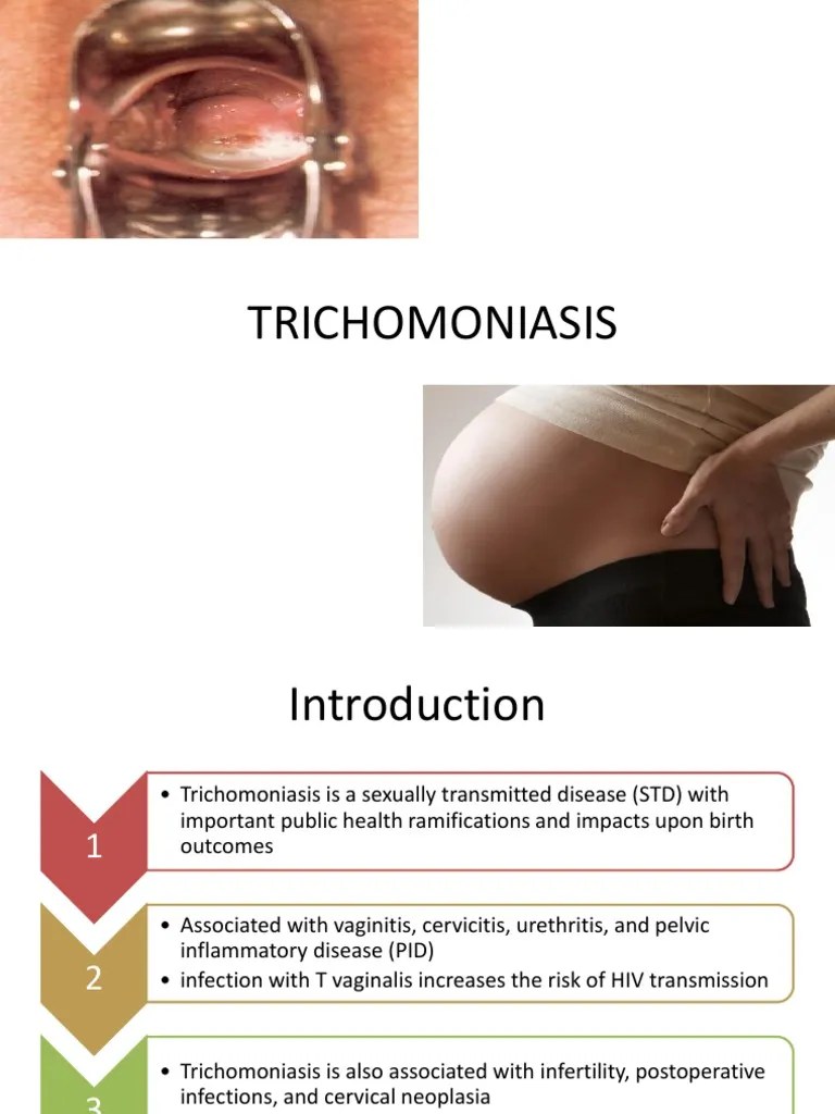 TRICHOMONIASIS Sexually Transmitted Infection Human Sexuality
