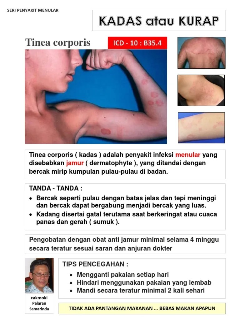 Kadas (Tinea Corporis) | PDF