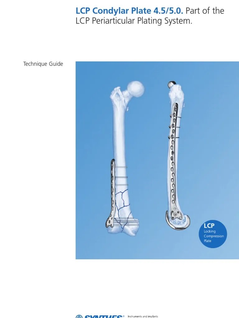 SynthesLCP Condylar Plate 4.55.0 Screw Knee