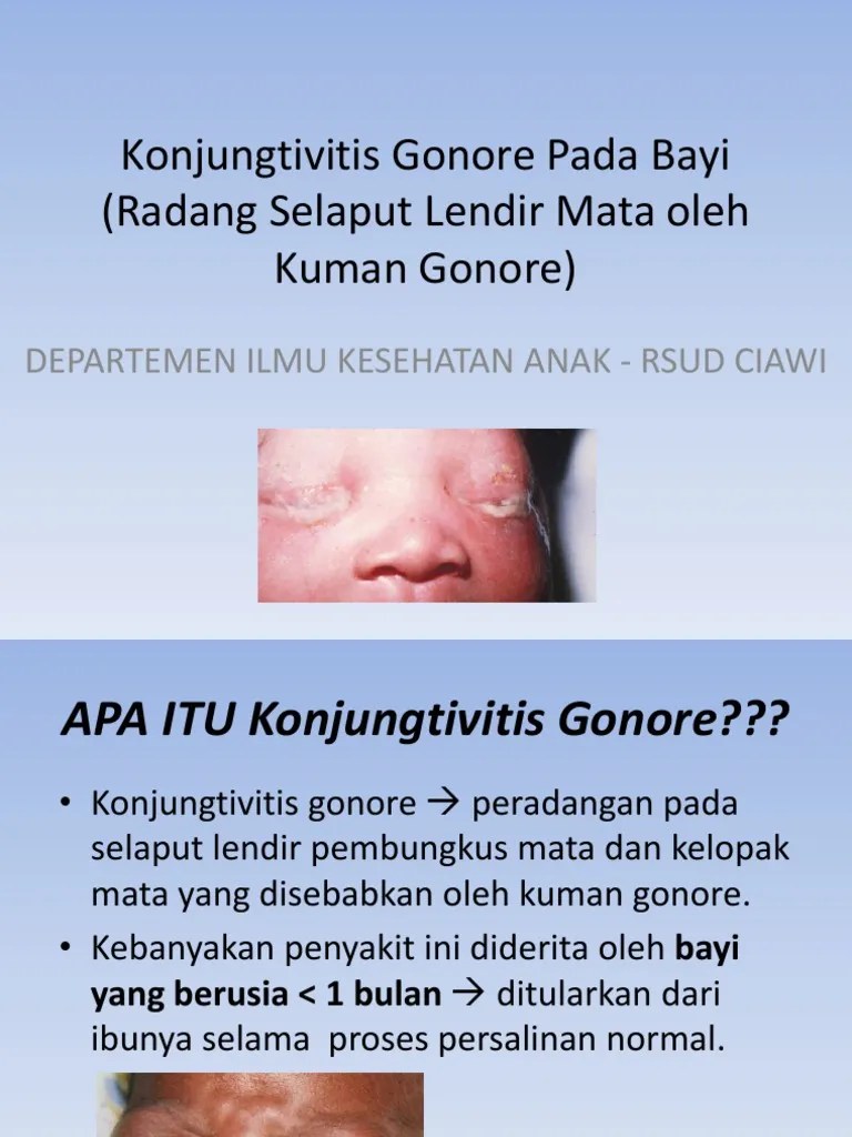 Konjungtivitis Gonore PDF