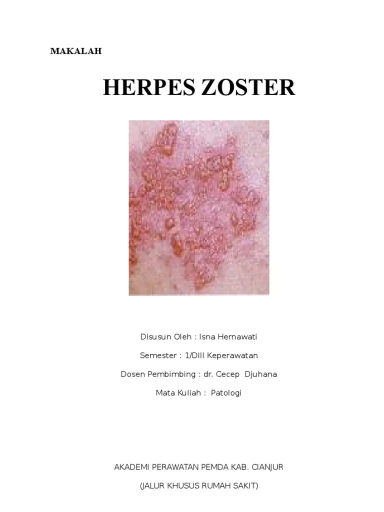 ASKEP HERPES ZOSTER PDF