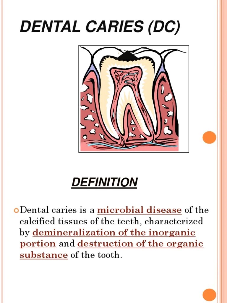 Dental Caries PDF Tooth Enamel Dentin