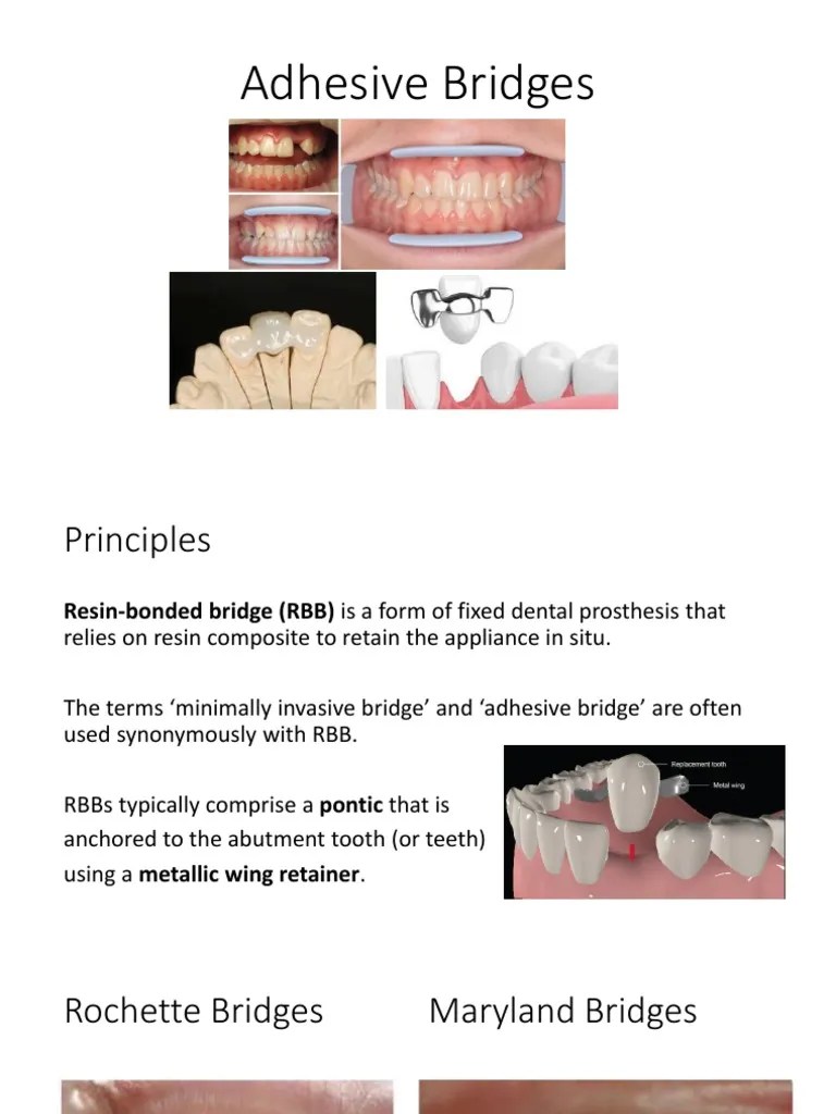Adhesive Bridges PDF Tooth Enamel Dentistry Branches