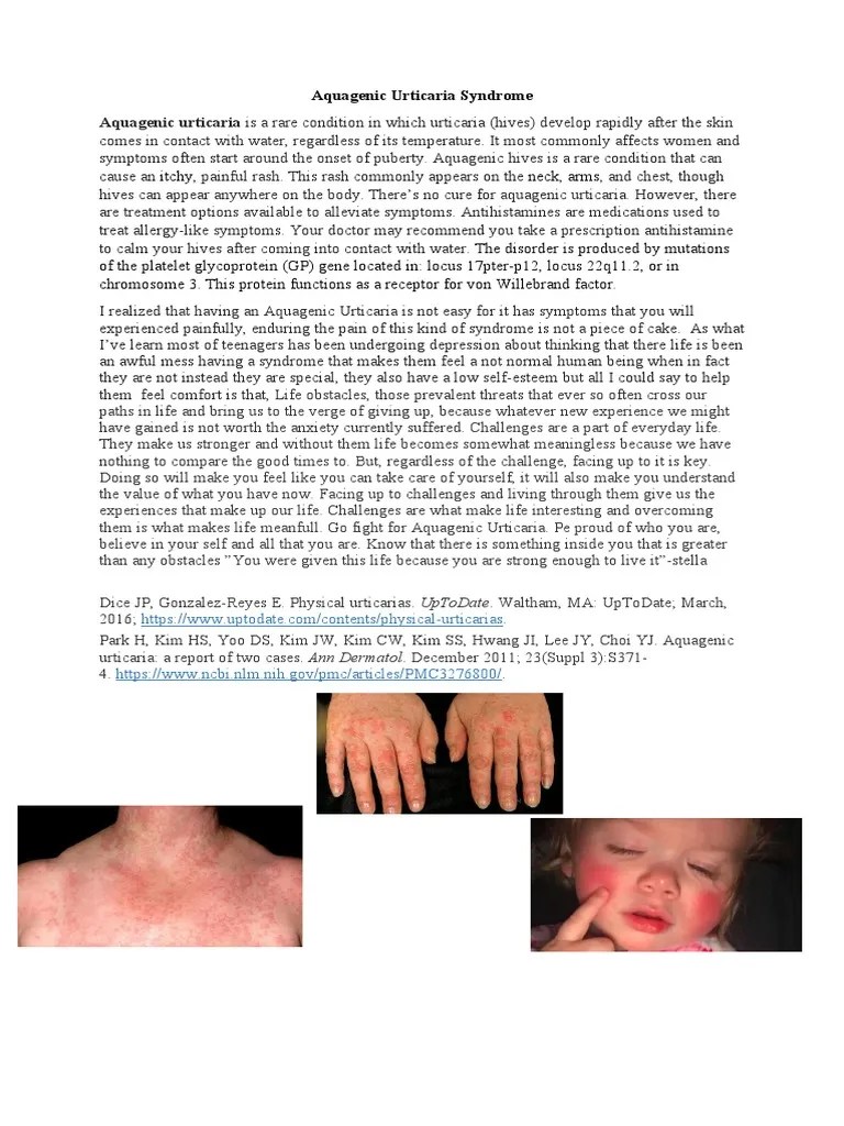 Aquagenic Urticaria Syndrome 24 PDF Clinical Medicine Diseases