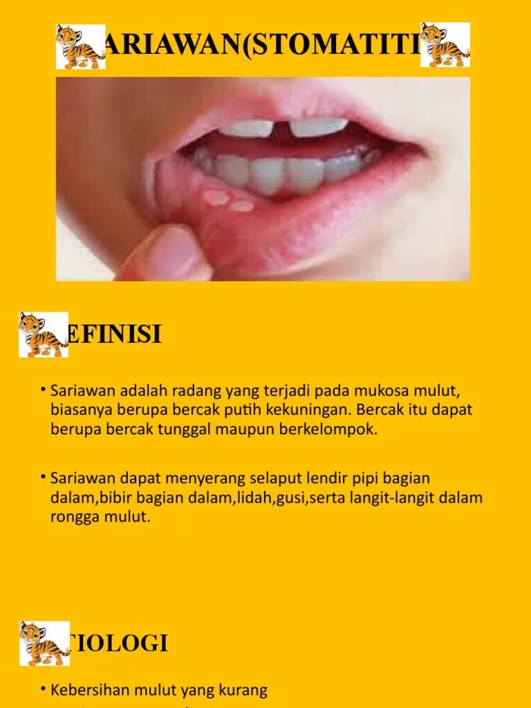 Sariawan (Stomatitis) - Ilmu Penyakit | PDF