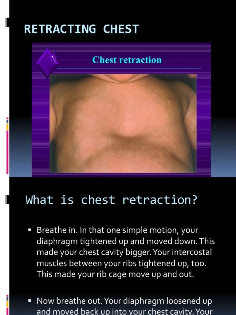 Chest Retraction PDF Thorax Breathing