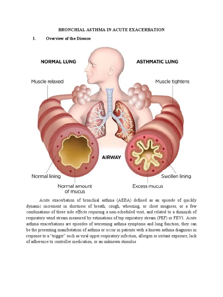 Bronchial Asthma in Acute Exacerbation Case Study PDF Lung Asthma