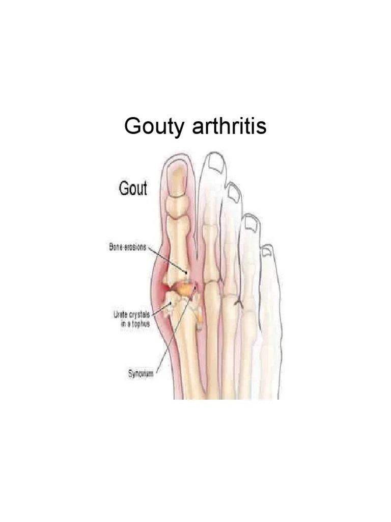 Gouty Arthritis Arthritis