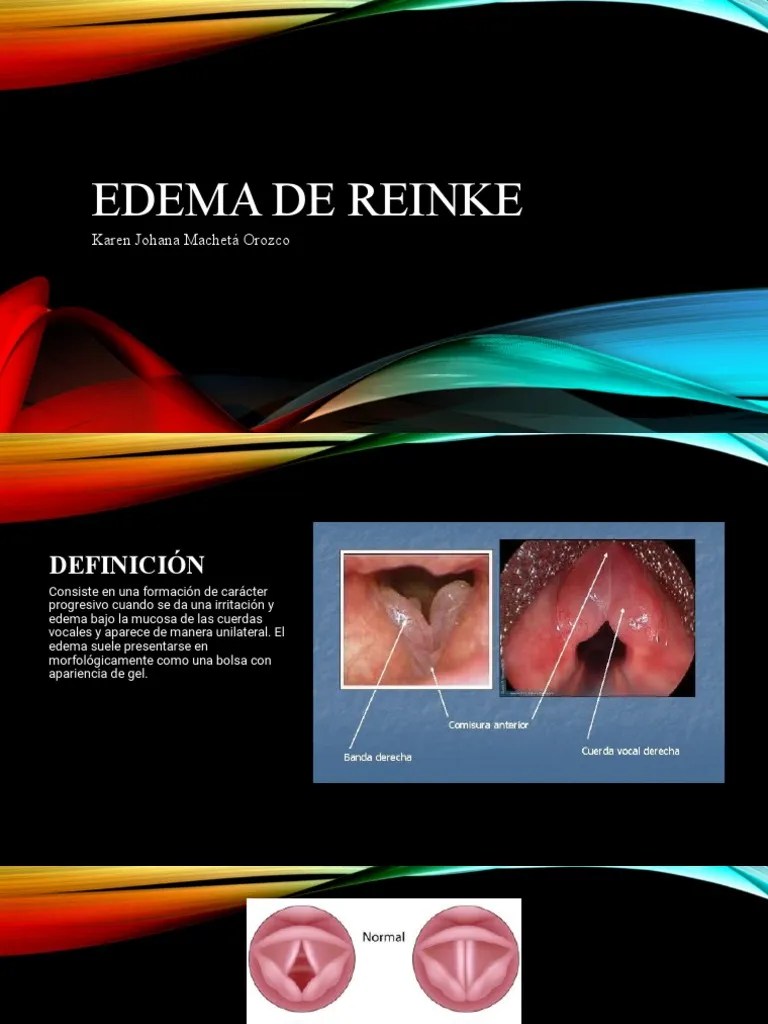 Edema de Reinke PDF