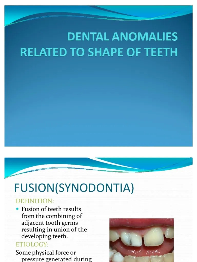 Dental Anomalies Related to Shape of Teeth Human Tooth Tooth Enamel