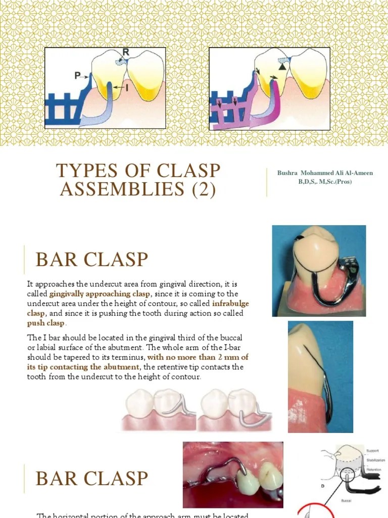 12) Types of Clasp Assemblies (2) PDF Dentistry Branches