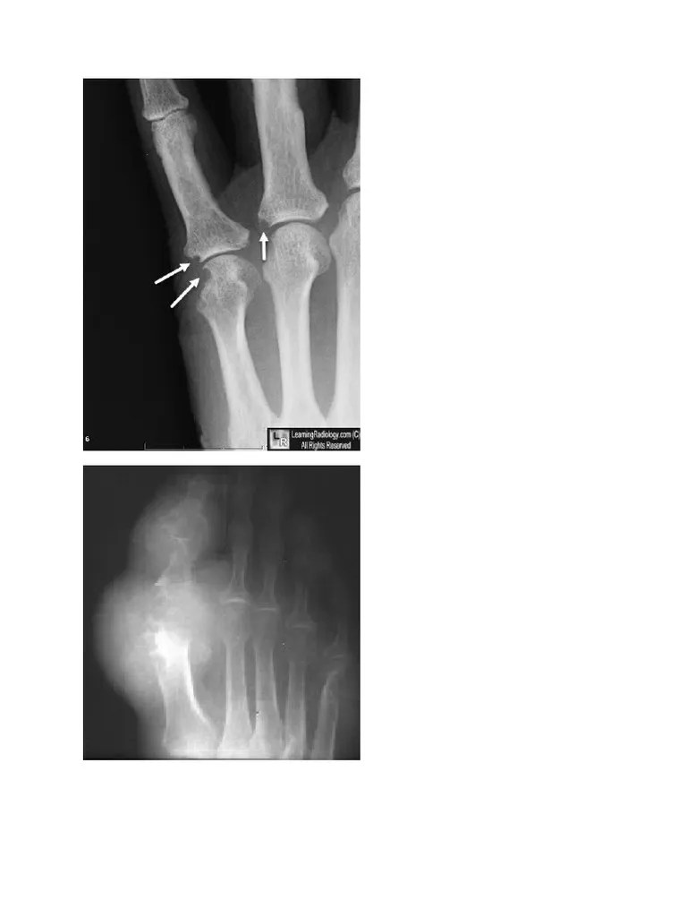 Arthritis Radiologi PDF