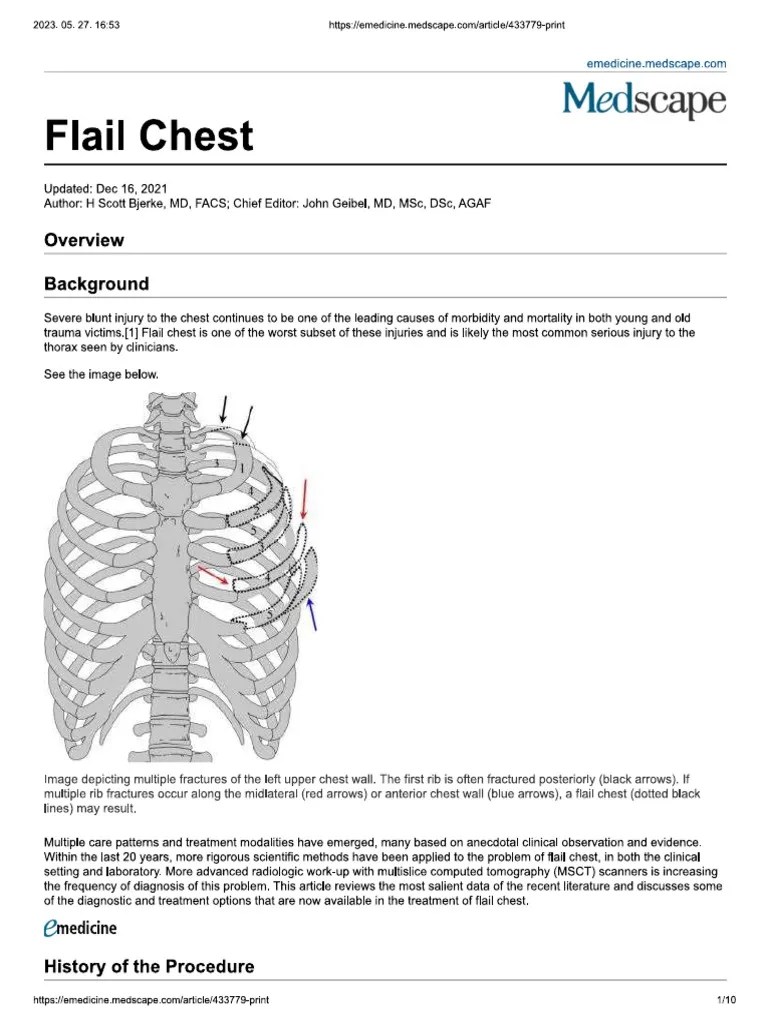 Flail Chest PDF