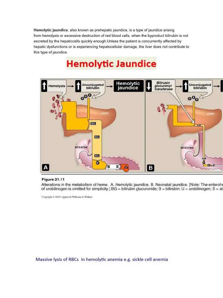 Hemolytic Jaundice PDF Tissue (Biology) Body Fluids