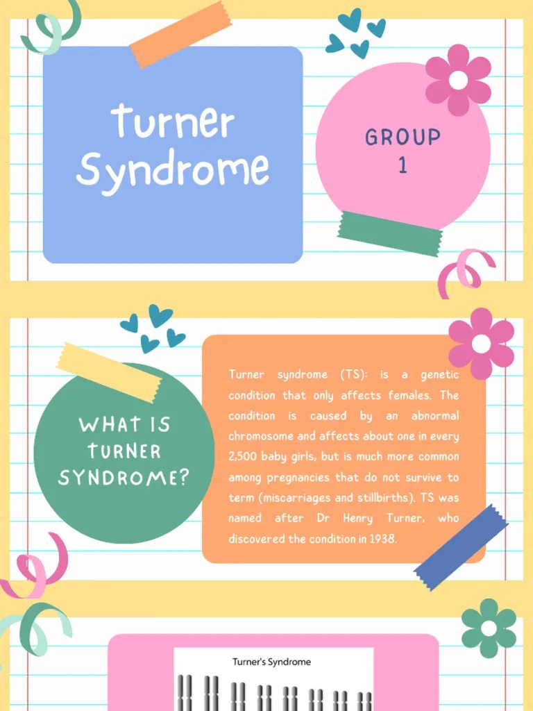 Turner Syndrome PDF Endocrine System Health Sciences