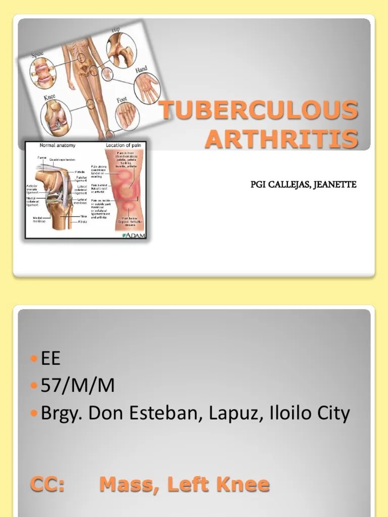 Tuberculous Arthritis PDF Joint Arthritis