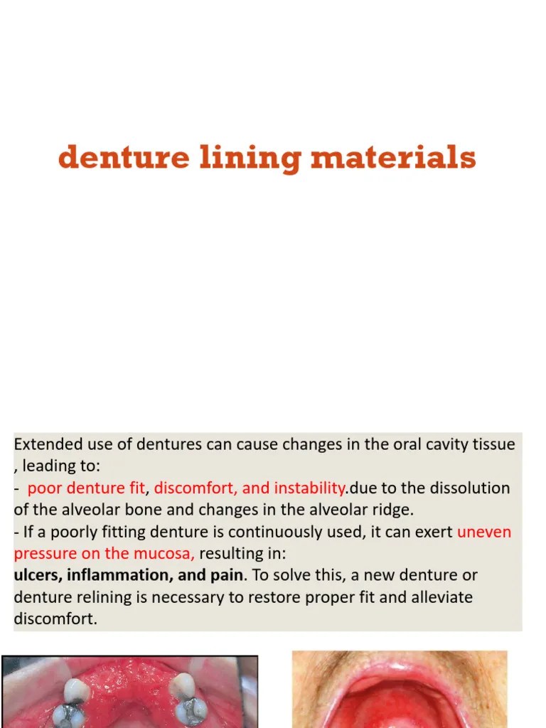 Denture Lining Materials... 5 PDF Dentures Poly(Methyl Methacrylate)