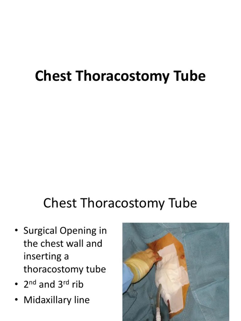 A Comprehensive Guide to Chest Thoracostomy Tubes Indications, Types
