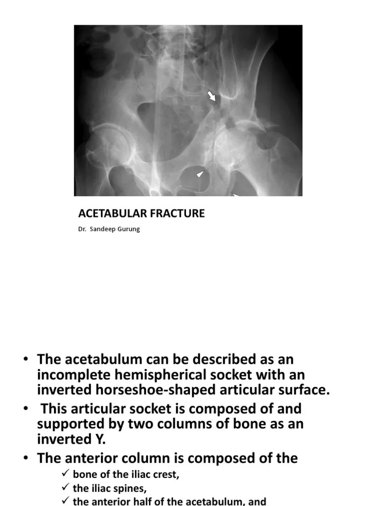 Acetabular Fracture Hip Pelvis