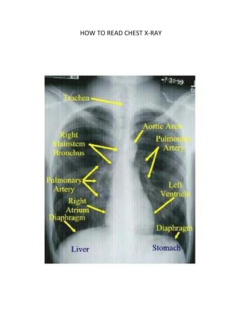 How To Read Chest XRay PDF Lung Animal Anatomy