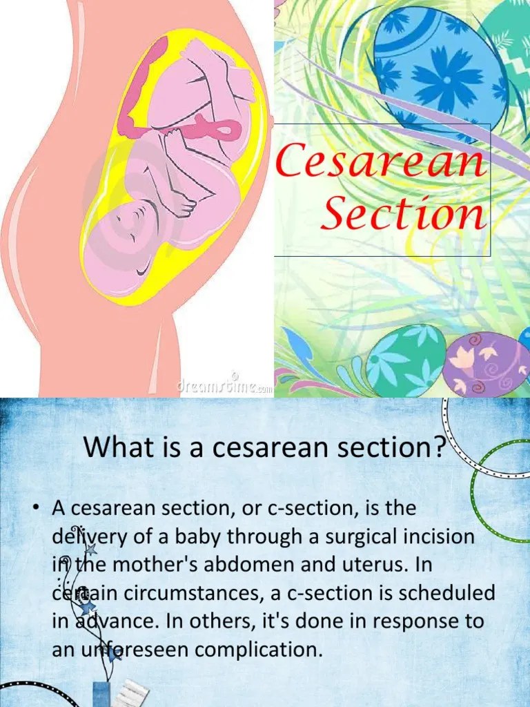 Cesarean Section Anesthesia Caesarean Section