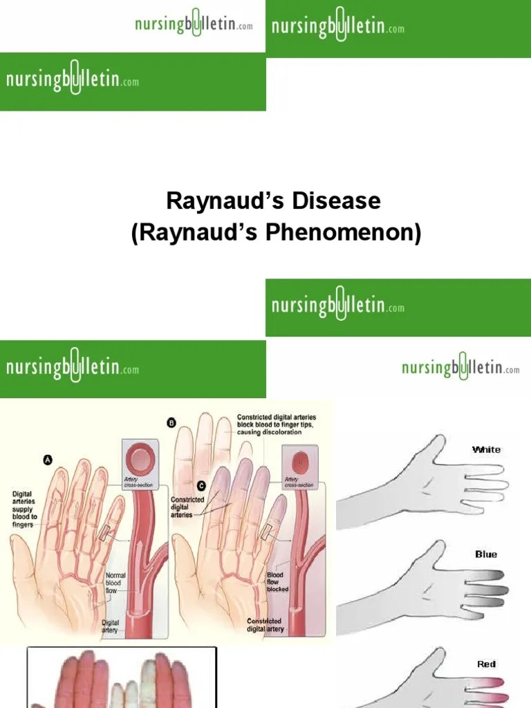 Raynaud's Disease Cardiovascular System Angiology