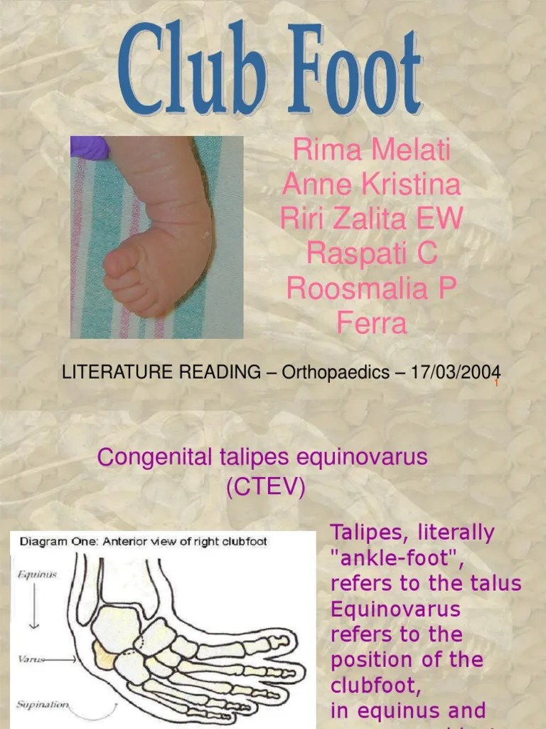 Club Foot.ppt Foot Orthopedic Surgery
