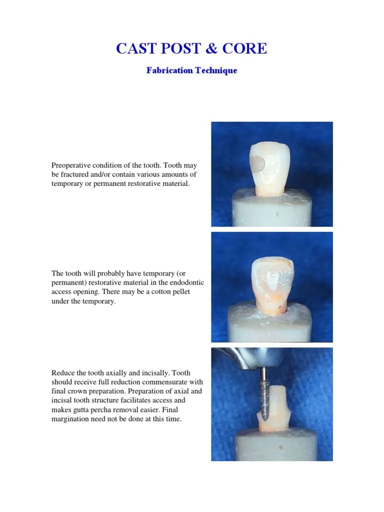 Post and Core Fabrication PDF Dentistry Branches Dentistry