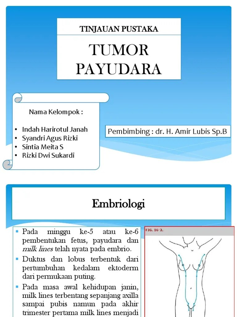Tumor Payudara