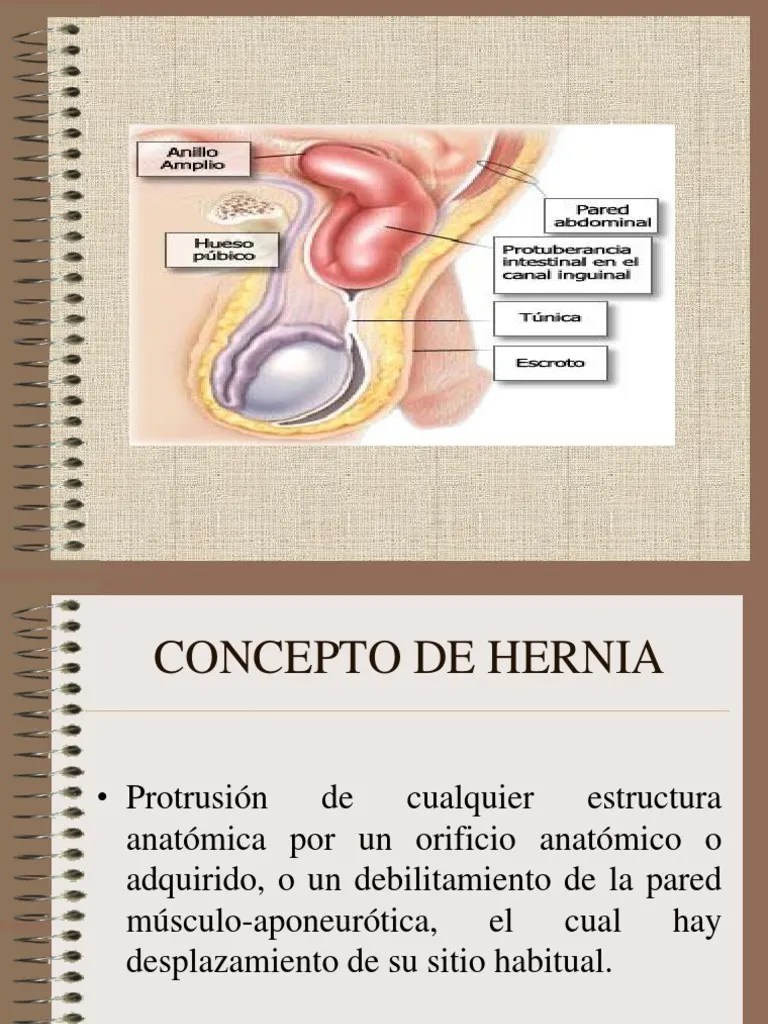 Hernia Inguinal 120912212802 Phpapp01 PDF Abdomen Medicina CLINICA