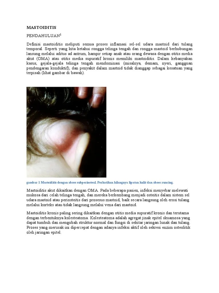 Mastoiditis Gambar 1 Mastoiditis Dengan Abses Subperiosteal Perhatikan Hilangnya Lipatan Kulit Dan Abses Runcing