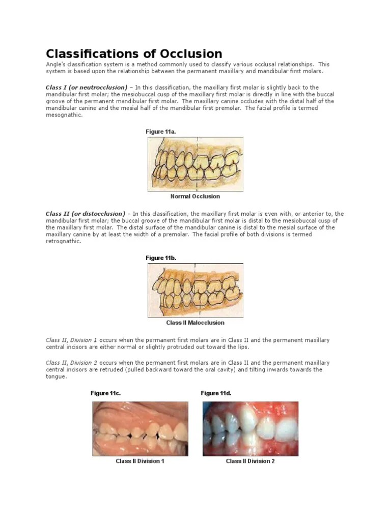 Classifications of Occlusion Human Anatomy Mouth Free 30day