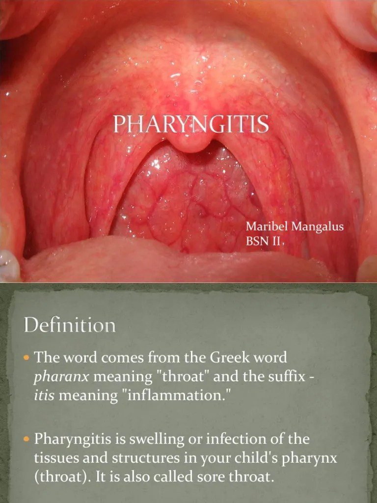Pharyngitis Tonsilitis Public Health Medical Specialties
