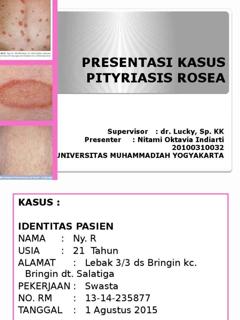 Presentasi Kasus Pitiriasis Rosea