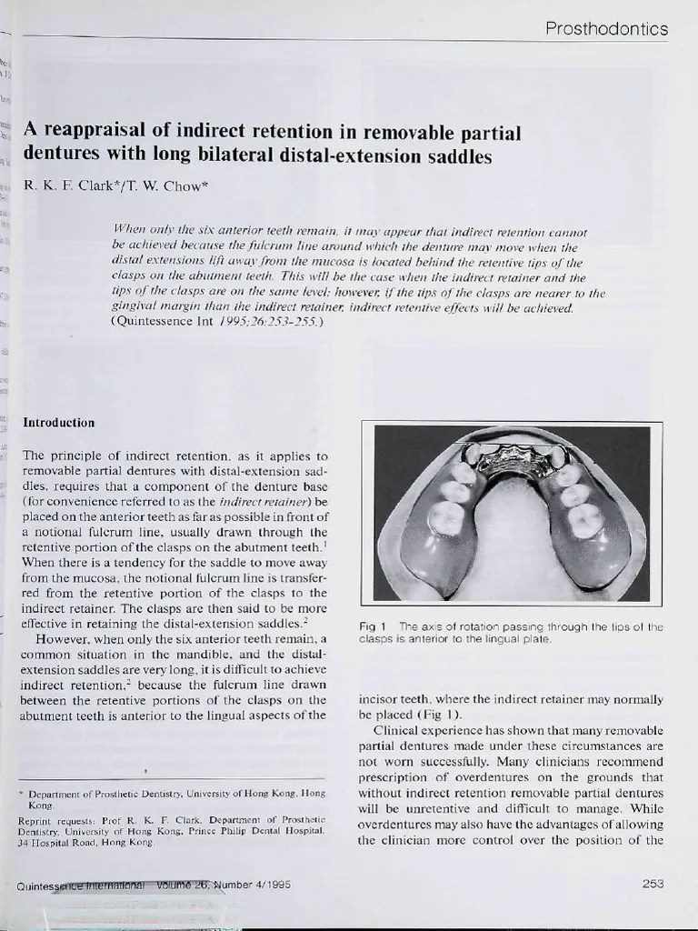 A Reappraisal of Indirect Retention in Removable Partial Dentures With