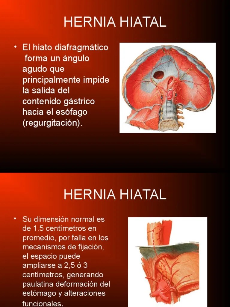 Hernia Hiatal La enfermedad por reflujo gastroesofágico