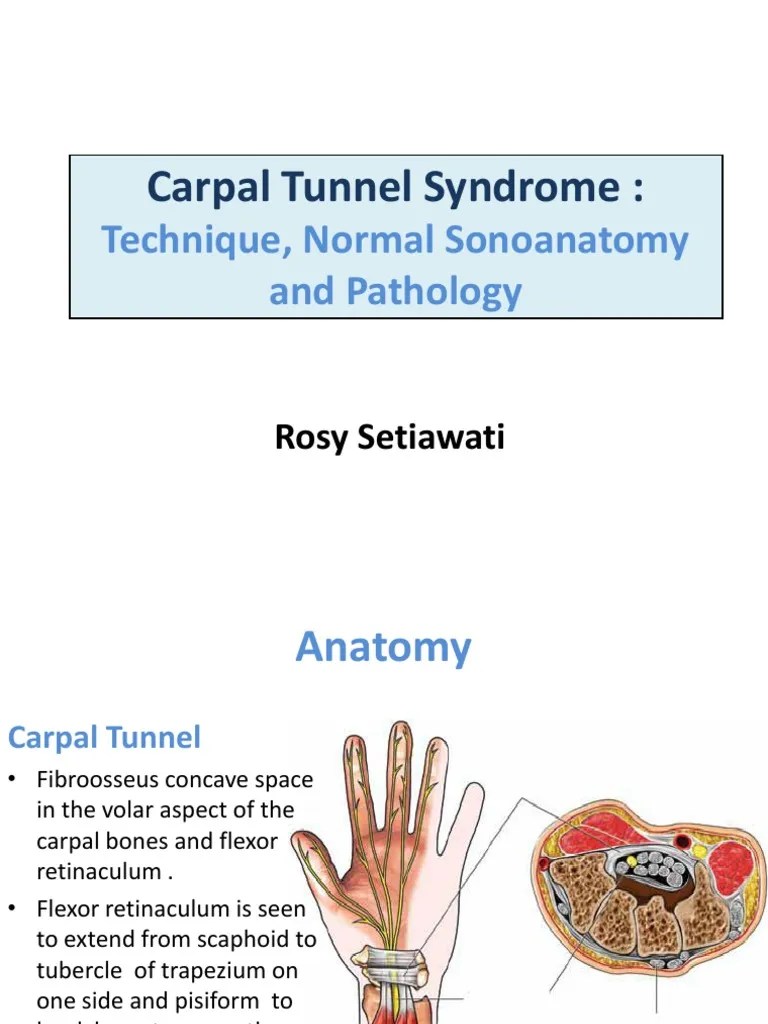 Carpal Tunnel Syndrome Carpal Tunnel Syndrome Hand