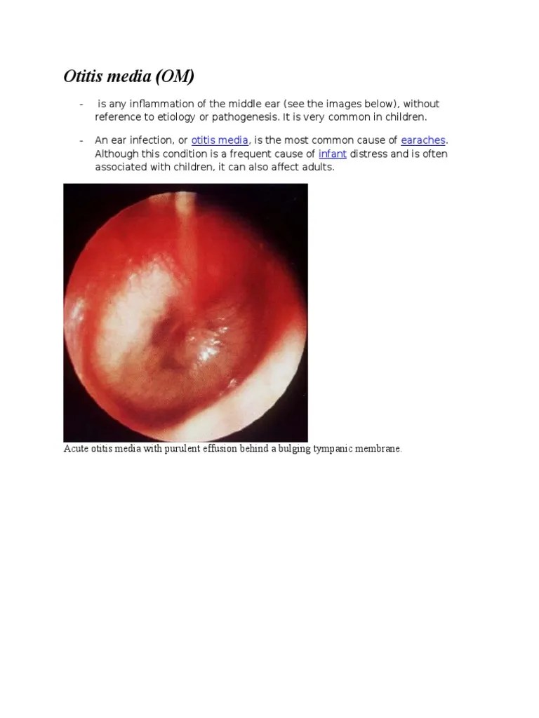 Otitis Media Medicine Diseases And Disorders