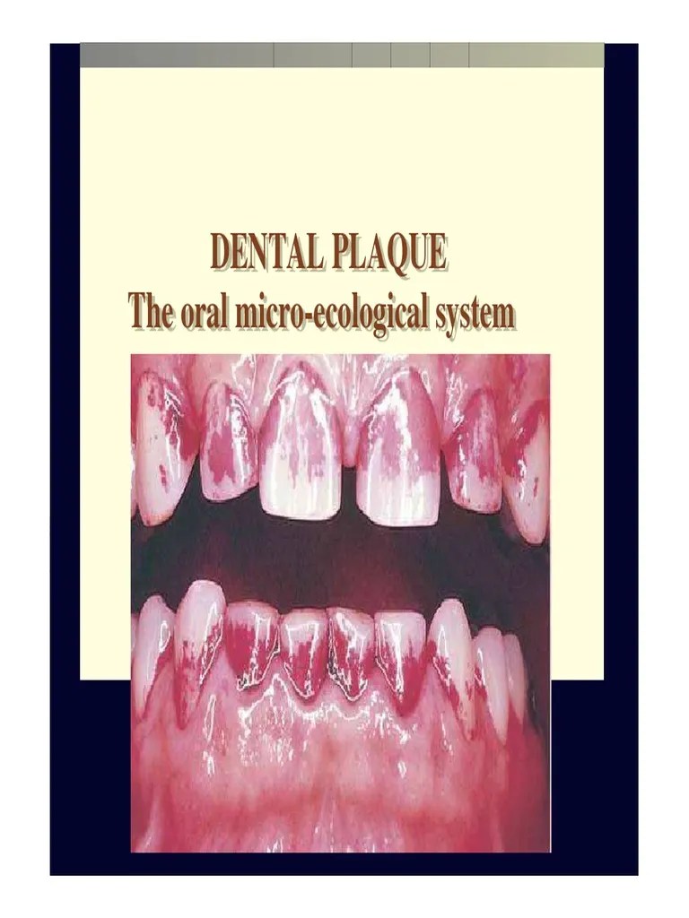 Local Plaque and Plaque Retentive Factors. 2013ppt Periodontology